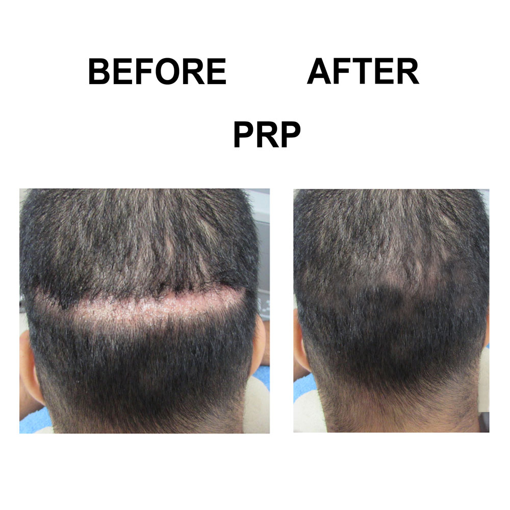 PRP for Hair Growth | Skin Care Speciality Centre